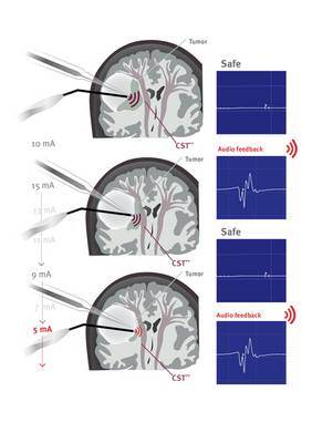 Mappingsauger Neurochirurgie