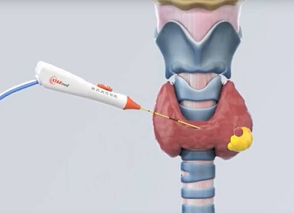 starmed schilddruese